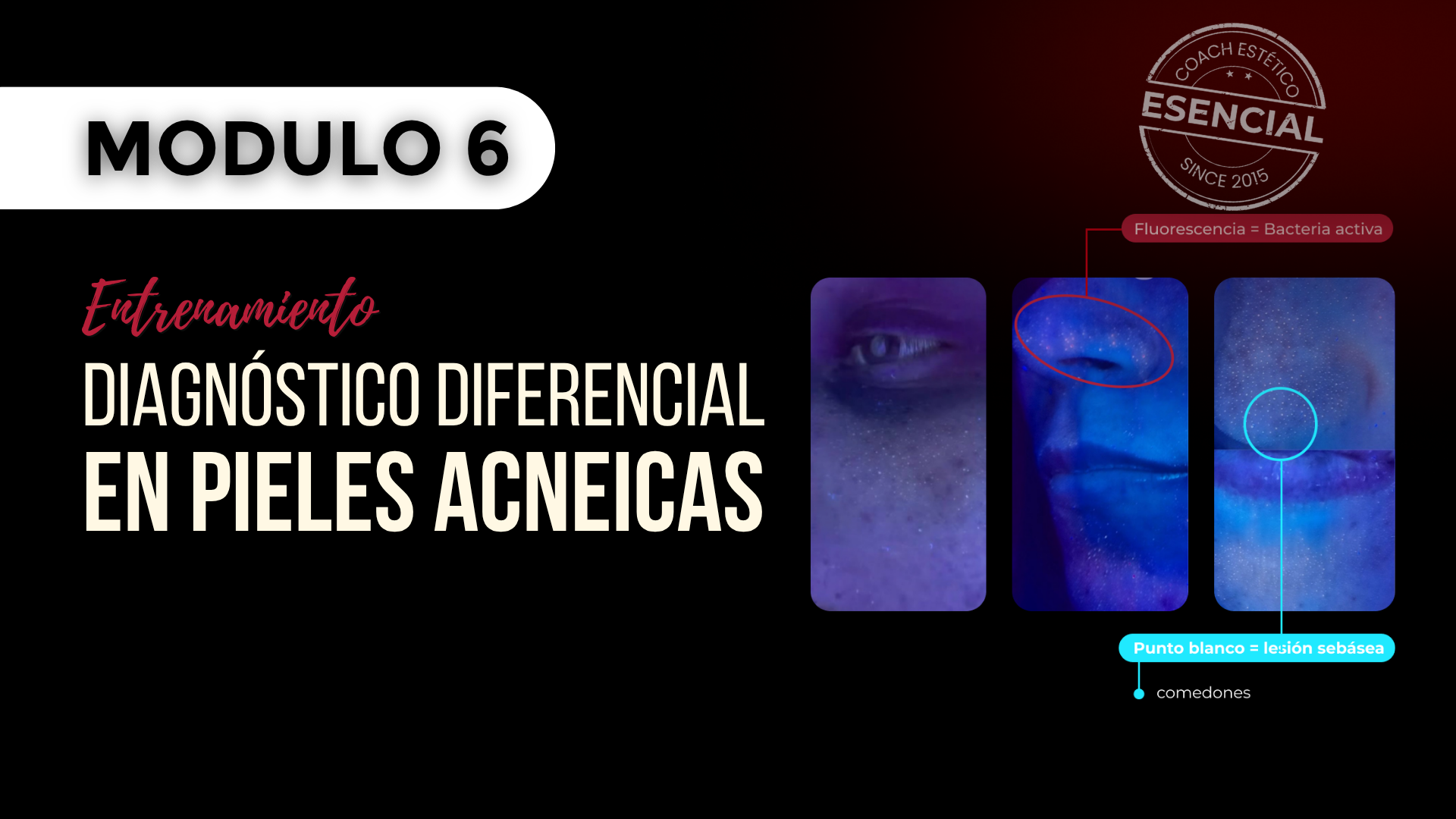 Módulo 06 — Diagnóstico diferencial en pieles acneicas