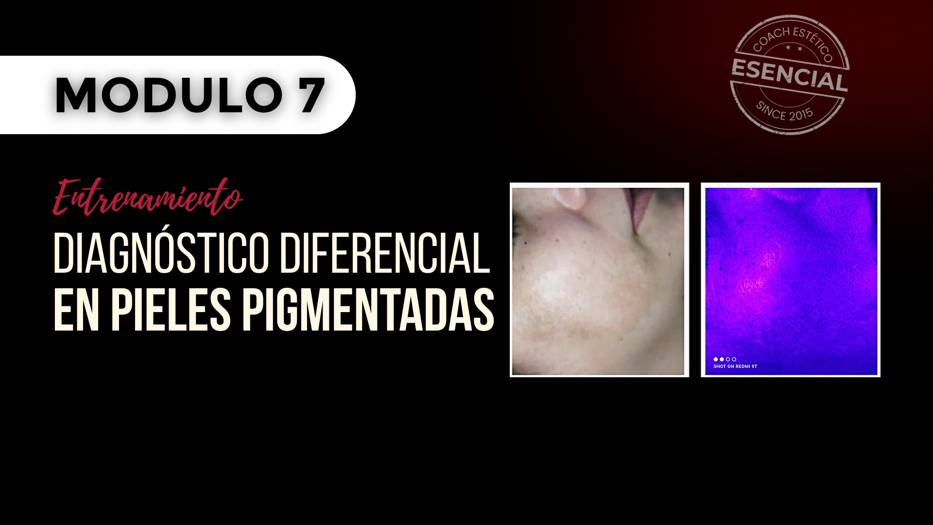 Módulo 07 — Diagnóstico diferencial en pieles pigmentadas